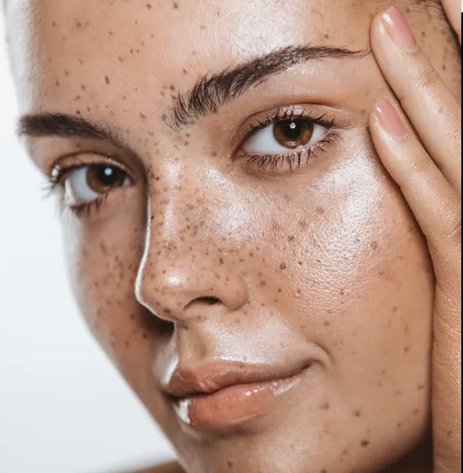 Pigmentation & Sun Damage. The why's, what's & treatment that can help.